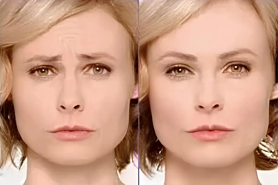 side by side of womans face before and after botox treatment