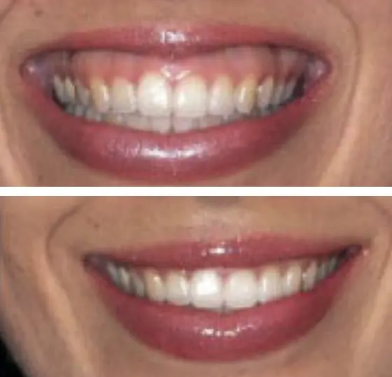 before and after image of lips with a gummy smile after botox