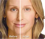 split screen of womans face before and after juvederm treatment