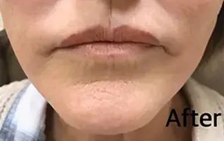 lips after mint pdo threads