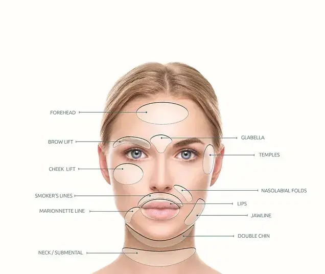 areas of a face that mint pdo treatment can be administered to