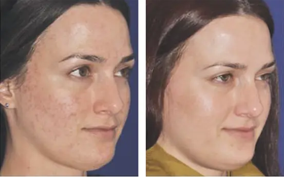 side profile of woman's face before and after acne from microneedling