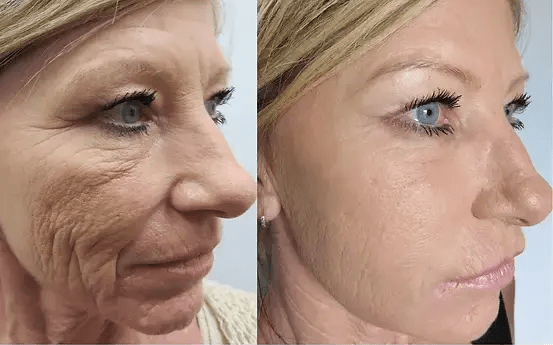 profile view of woman's face before and after filler