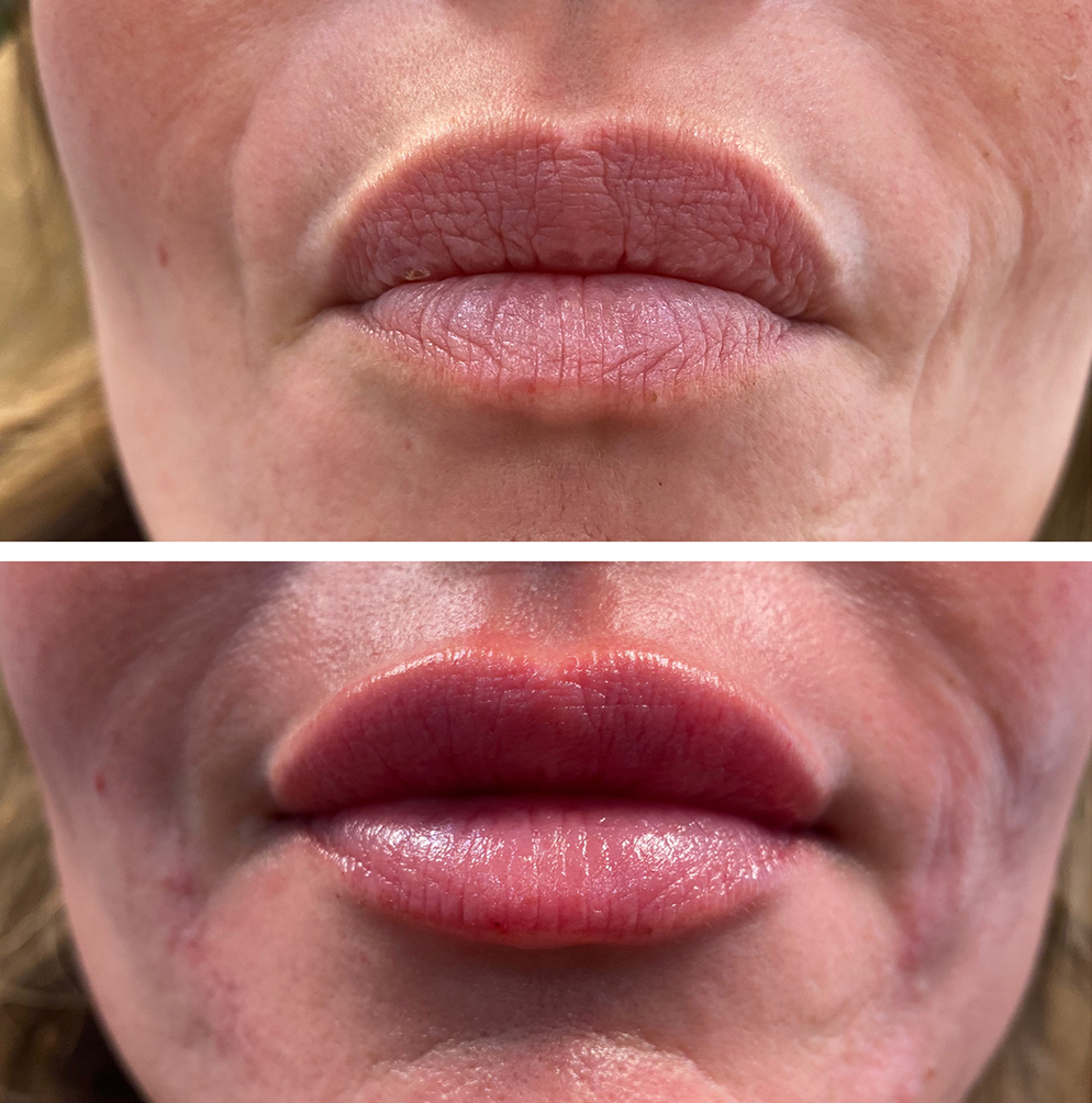 up close shot of lips before and after injection