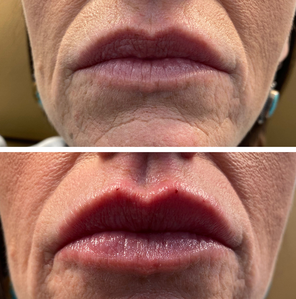 up close shot of lips before and after injection